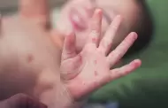 �Atenci�n! UGEL Chiclayo dispone medidas preventivas en colegios por infecci�n viral "mano, pie y boca"
