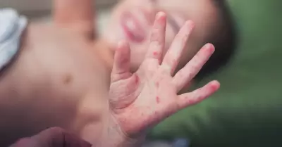 Infecci�n viral "mano, pie y boca"