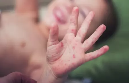 Infecci�n viral "mano, pie y boca"