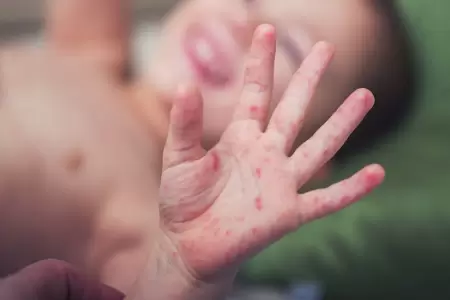 Infecci�n viral "mano, pie y boca"