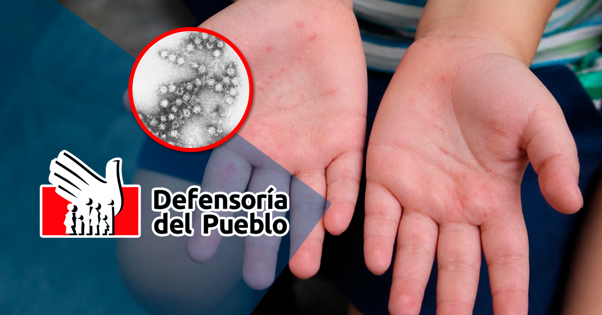 Virus Coxsackie: Defensoría del Pueblo exhorta a ministerios reforzar medidas ante incremento de casos en colegios