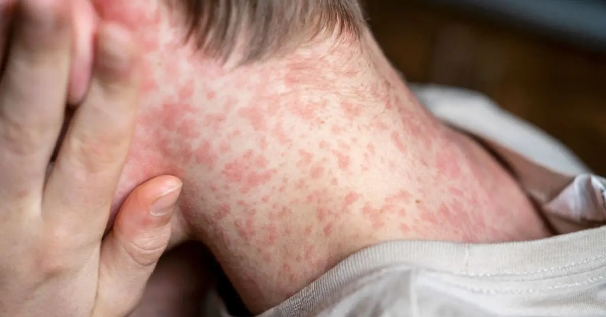 Alerta por sarampión en Perú: Experto advierte que brote podría escalar a una epidemia