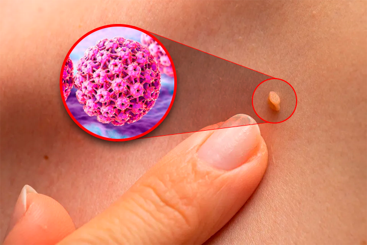 Tras contraer el virus, las enfermedades suelen manifestarse a trav�s de verrugas.
