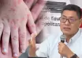 Lima registra 20 casos de ni�os infectados con el virus Coxsackie, seg�n Minedu