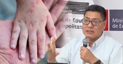 Minedu y Minsa informan sobre los casos de ni�os infectados con el virus Coxsack