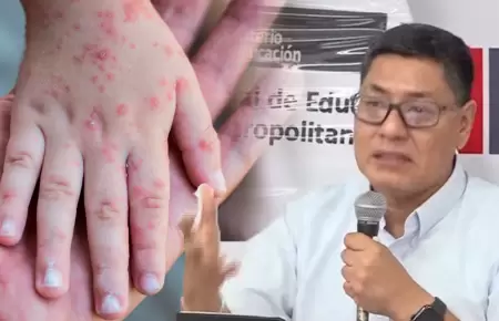 Minedu y Minsa informan sobre los casos de ni�os infectados con el virus Coxsack