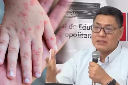 Minedu y Minsa informan sobre los casos de ni�os infectados con el virus Coxsack