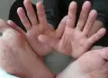 �Adultos tambi�n pueden contagiarse con el virus Coxsackie? Experto del Minsa responde