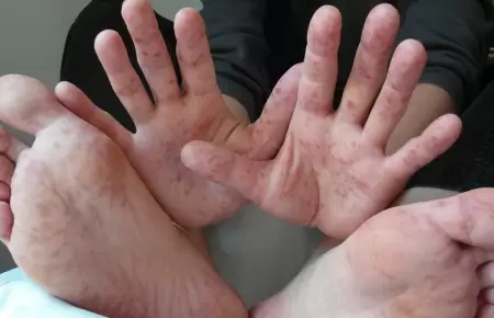�Adultos tambi�n pueden contagiarse con el virus Coxsackie?