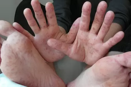 �Adultos tambi�n pueden contagiarse con el virus Coxsackie?