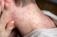 Alerta por sarampi�n en Per�: Experto advierte que brote podr�a escalar a una epidemia