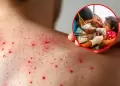 Per� en emergencia sanitaria: Brote de sarampi�n suma m�s de 300 casos con la mayor�a en Puno