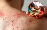 Per� en emergencia sanitaria: Brote de sarampi�n suma m�s de 300 casos con la mayor�a en Puno