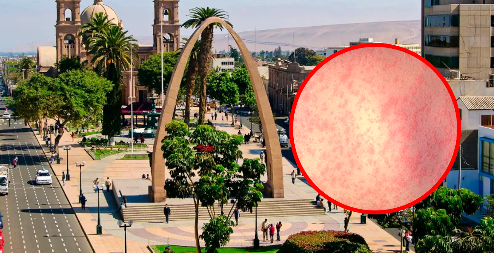 Confirman 3 nuevos casos de sarampión en Tacna: la región reporta 8 casos en total