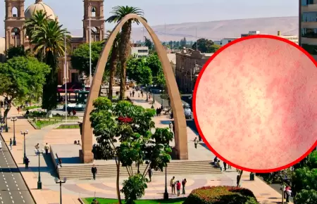 Casos de sarampi�n en Tacna