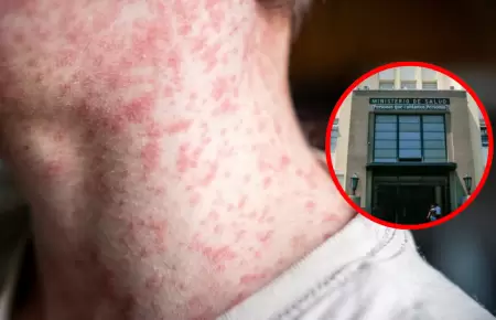 Minsa alerta m�s de 1790 casos de sarampi�n y advierte riesgo de transmisibilida