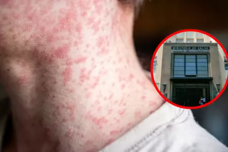 Minsa alerta m�s de 1790 casos de sarampi�n y advierte riesgo de transmisibilida