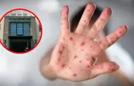 Alerta de sarampión: MINSA confirma más de 1780 casos a nivel nacional y advierte riesgo de contagio