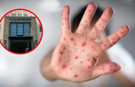 Minsa alerta m�s de 1780 casos de sarampi�n y advierte riesgo de transmisibilida