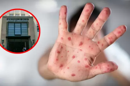 Minsa alerta m�s de 1780 casos de sarampi�n y advierte riesgo de transmisibilida