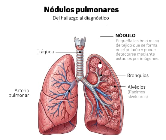 imagen indica la presencia de un N�dulo