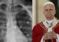 Papa Le�n XIV ser� hospitalizado este martes 13 para ser operado por n�dulo en el pulm�n