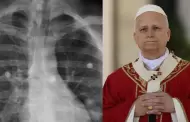 Papa León XIV será hospitalizado este martes 13 para ser operado por nódulo en el pulmón