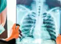 �Qu� es el adenocarcinoma pulmonar? El tumor extirpado al papa Le�n XIV tras su cirug�a en Roma