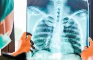 ¿Qué es el adenocarcinoma pulmonar? El tumor extirpado al papa León XIV tras su cirugía en Roma