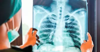 Diagnostican un adenocarcinoma pulmonar al papa Le�n XIV